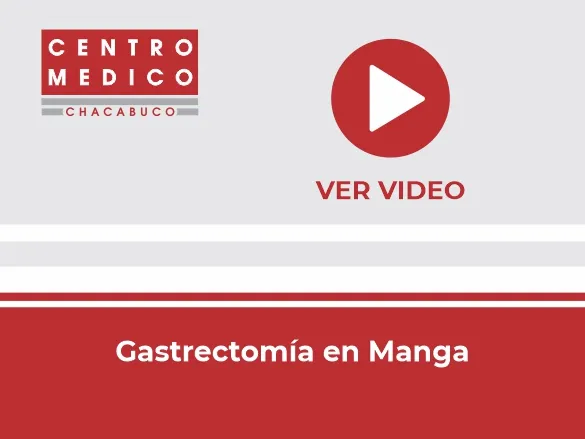 Miniatura del video: Gastrectomía en manga