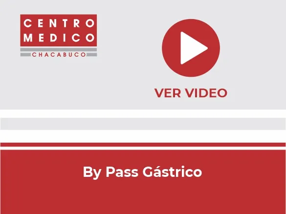 Miniatura del video: By Pass Gástrico