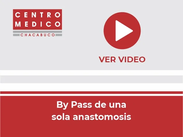 Miniatura del video: By pass gástrico de una sola anastomosis