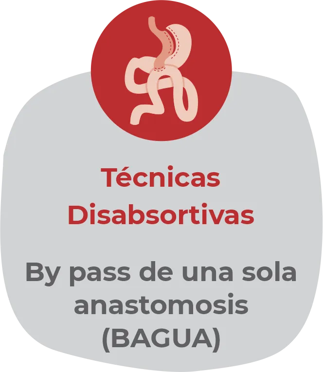 Ilustración del tipo de cirugía 3: derivación duodenal.