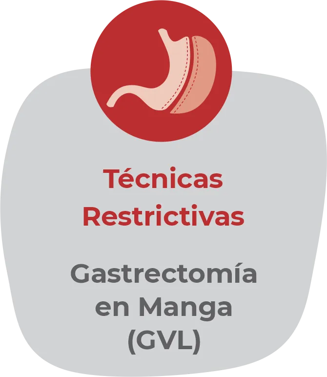 Ilustración del tipo de cirugía 1: reducción del estómago.