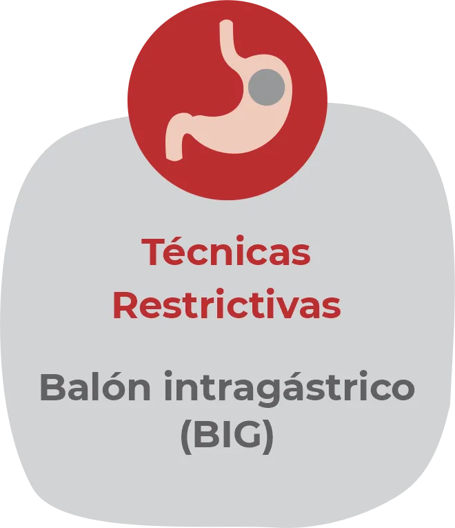 Ilustración del tipo de cirugía 4: by pass gástrico.